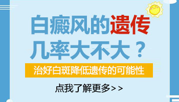 姑姑有白癜风侄子侄女得白癜风的几率大吗