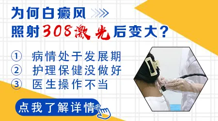 308治疗白癜风后扩散变大什么原因