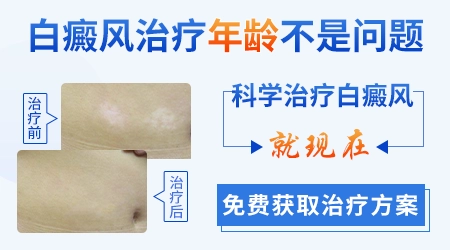 婴儿头皮上有白斑