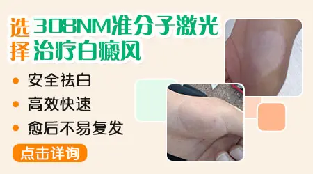 308激光治疗白斑多少钱