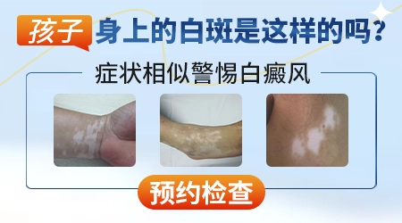 小孩大腿有一块皮肤比较白