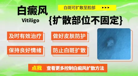 肚子有白癜风会不会扩散到脸上