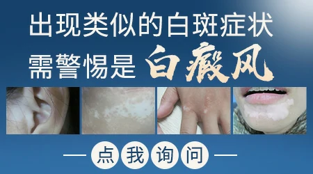 身上起白斑不痛不痒