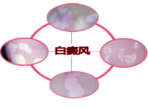 黑豆怎样吃治疗白癜风