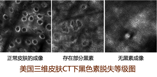 胸部出现白斑应该如何治疗