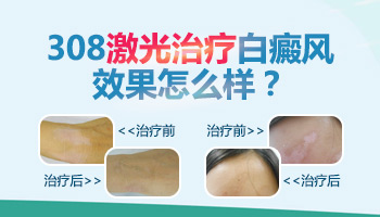 治疗白癜风哪里的308激光便宜