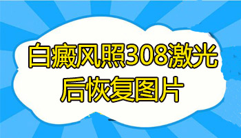 多久能治好白癜风 做308激光的恢复过程是怎么样