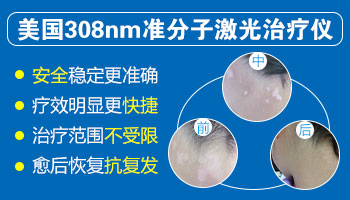 有用光疗仪治好手部白癜风的吗