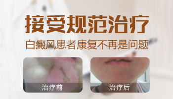 308准分子激光治疗后白斑变白了