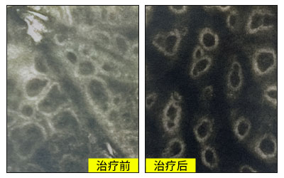 308准分子激光治疗后白斑变白了