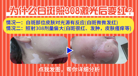 白癜风照完308发红发痒