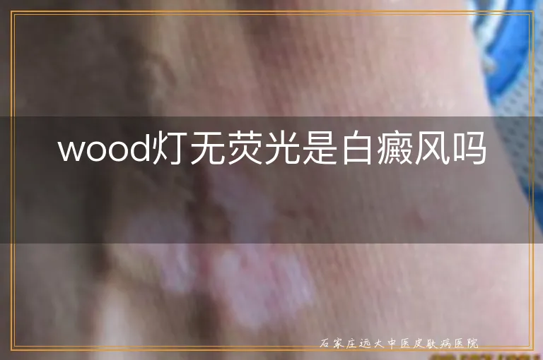 wood灯无荧光是白癜风吗