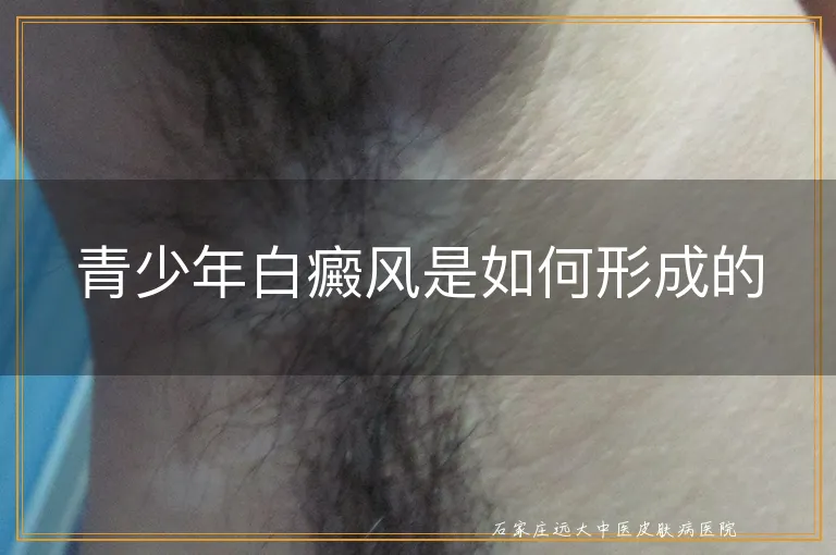 青少年白癜风是如何形成的