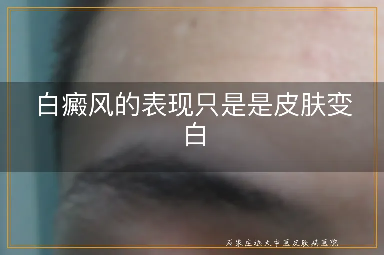 白癜风的表现只是是皮肤变白