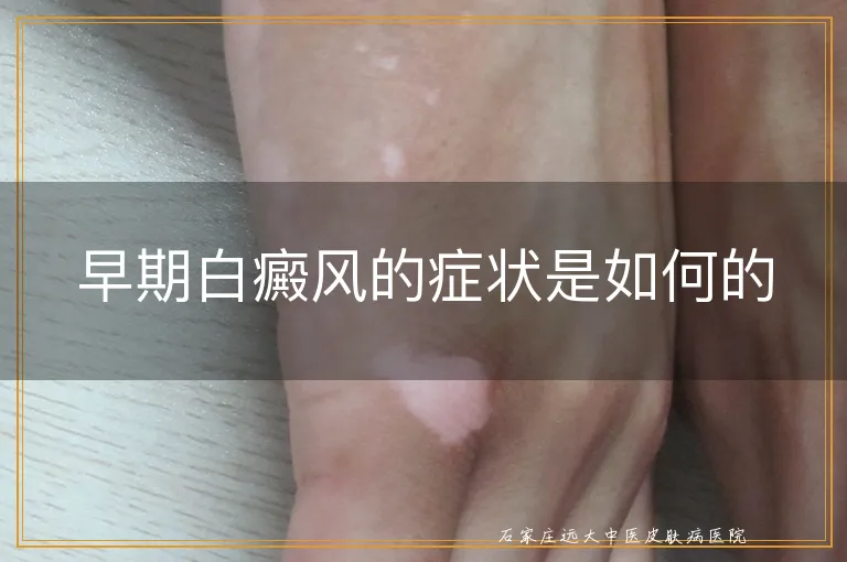 早期白癜风的症状是如何的