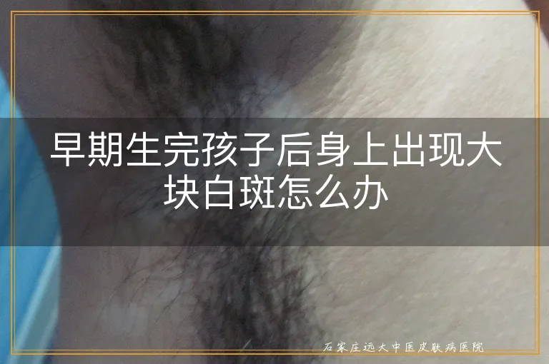 早期生完孩子后身上出现大块白斑怎么办