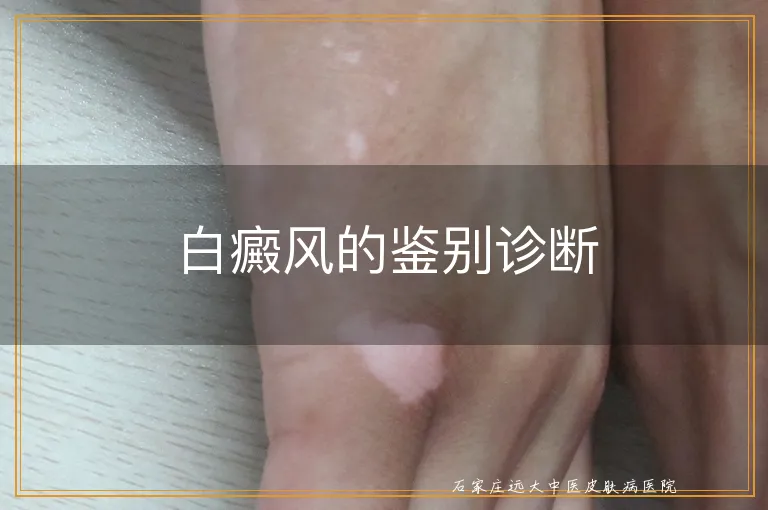 白癜风的鉴别诊断