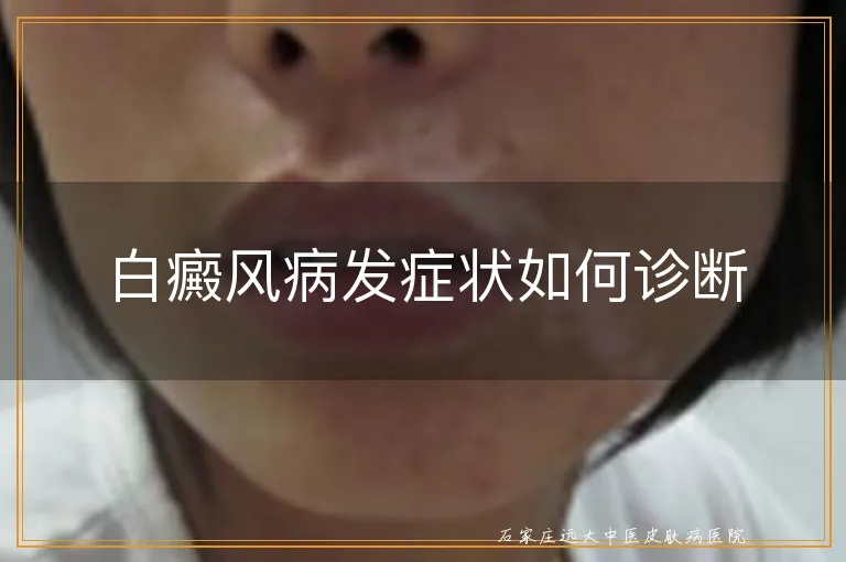 白癜风病发症状如何诊断