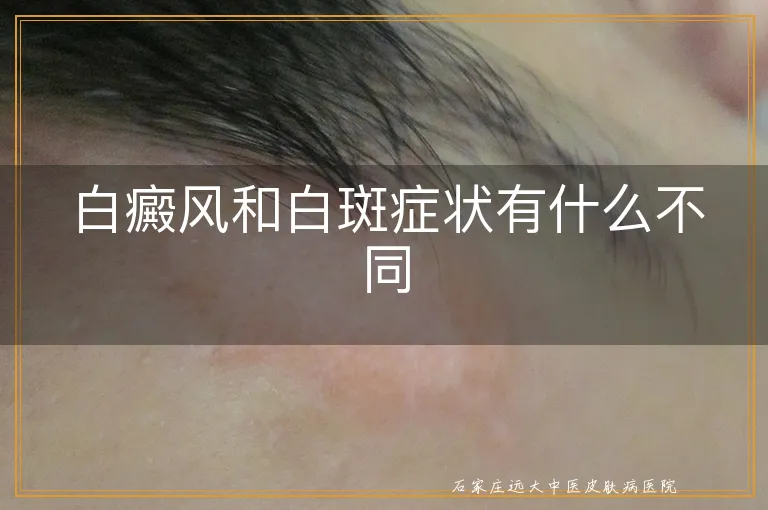 白癜风和白斑症状有什么不同