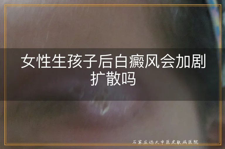 女性生孩子后白癜风会加剧扩散吗