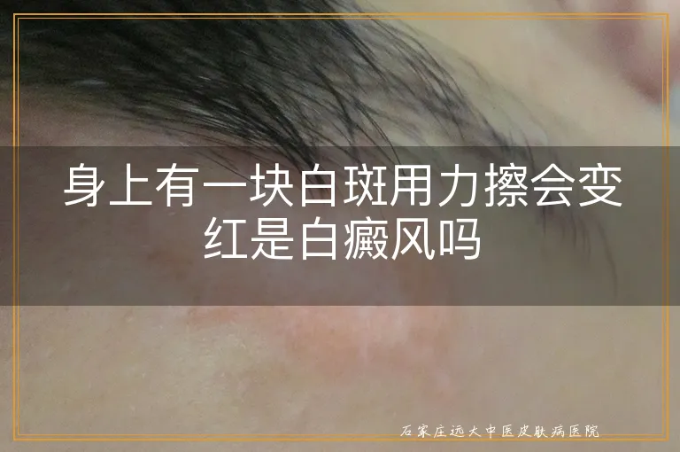 身上有一块白斑用力擦会变红是白癜风吗