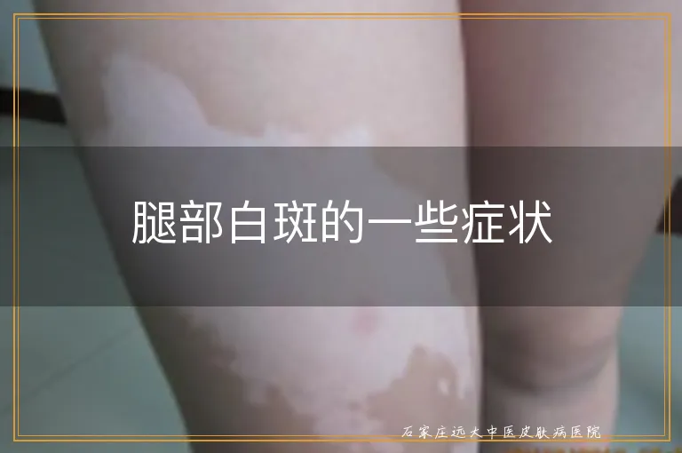 腿部白斑的一些症状