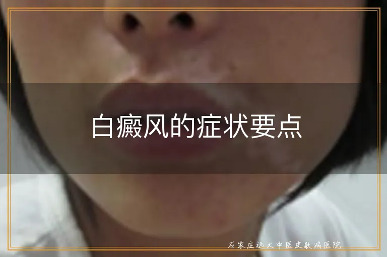 白癜风的症状要点