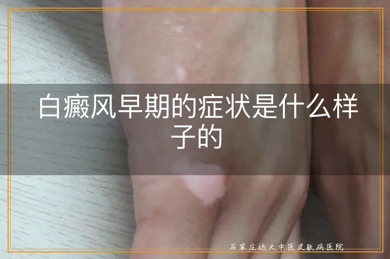 白癜风早期的症状是什么样子的