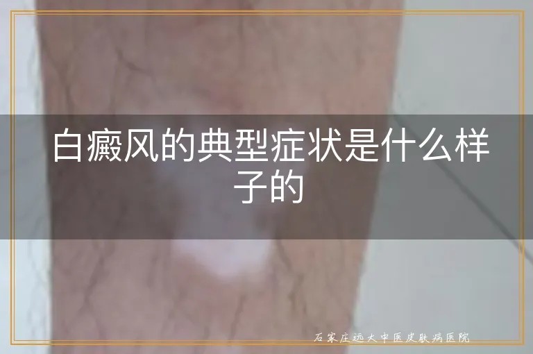 白癜风的典型症状是什么样子的