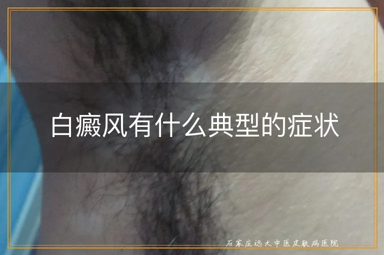 白癜风有什么典型的症状