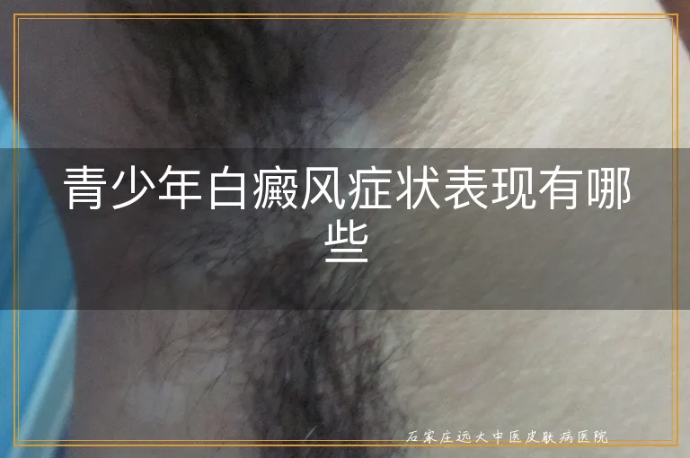 青少年白癜风症状表现有哪些