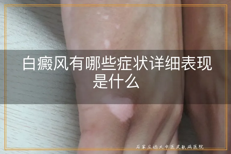 白癜风有哪些症状详细表现是什么