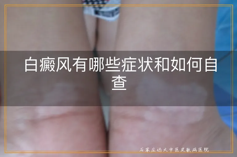 白癜风有哪些症状和如何自查