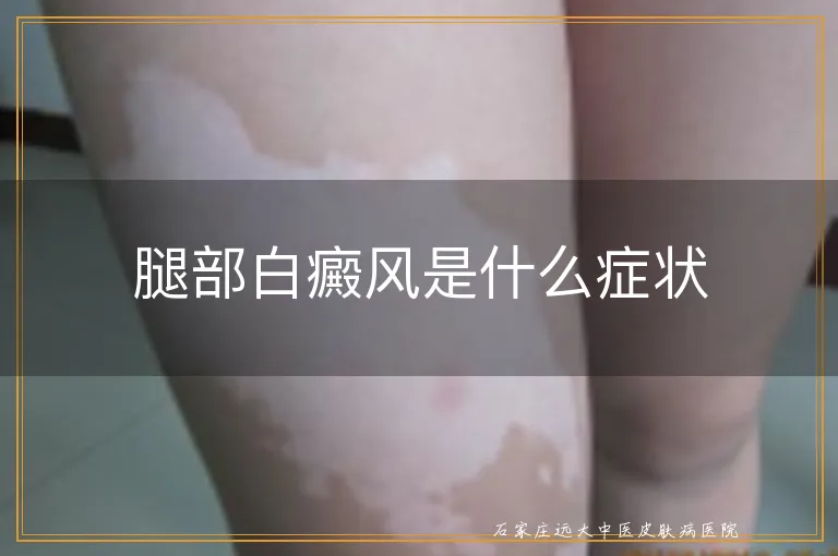 腿部白癜风是什么症状