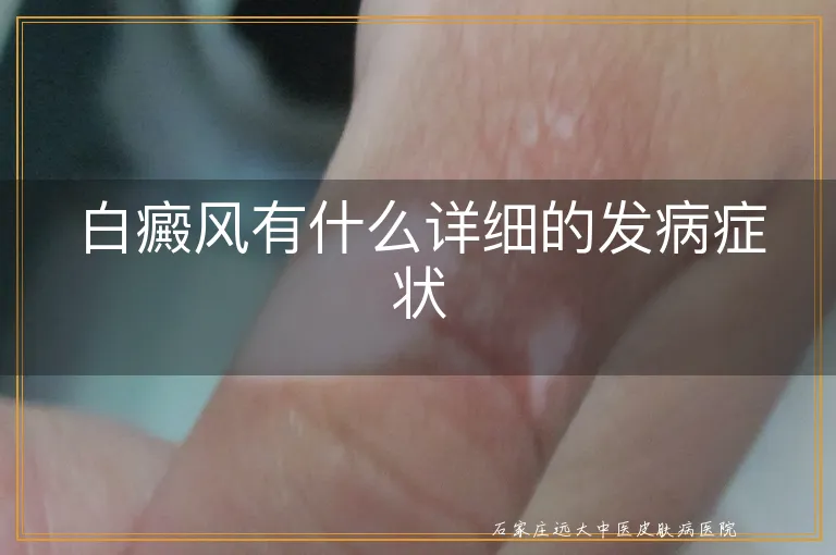 白癜风有什么详细的发病症状