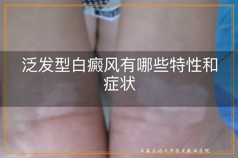 泛发型白癜风有哪些特性和症状