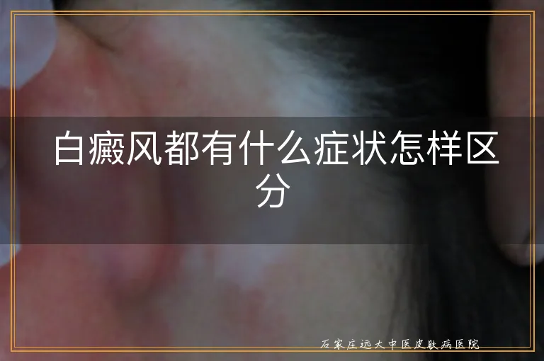 白癜风都有什么症状怎样区分