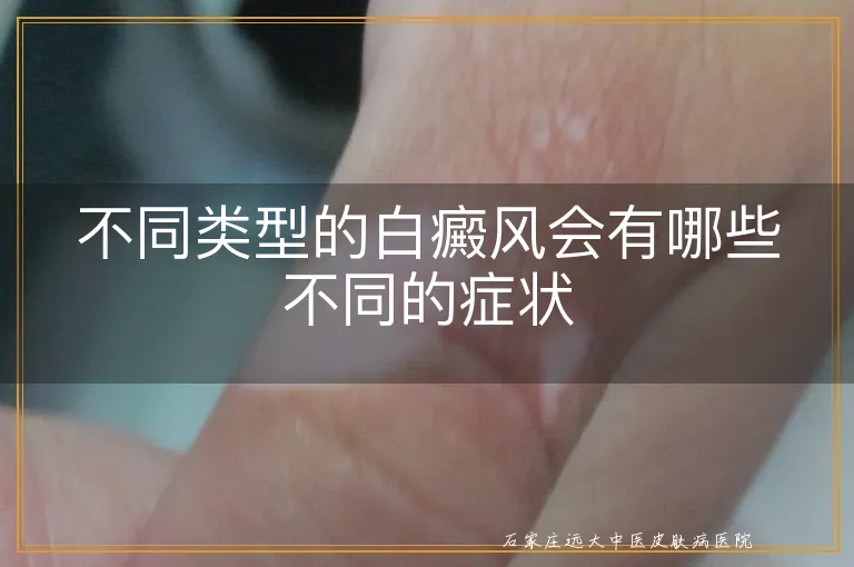 不同类型的白癜风会有哪些不同的症状