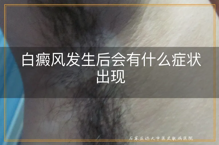 白癜风发生后会有什么症状出现