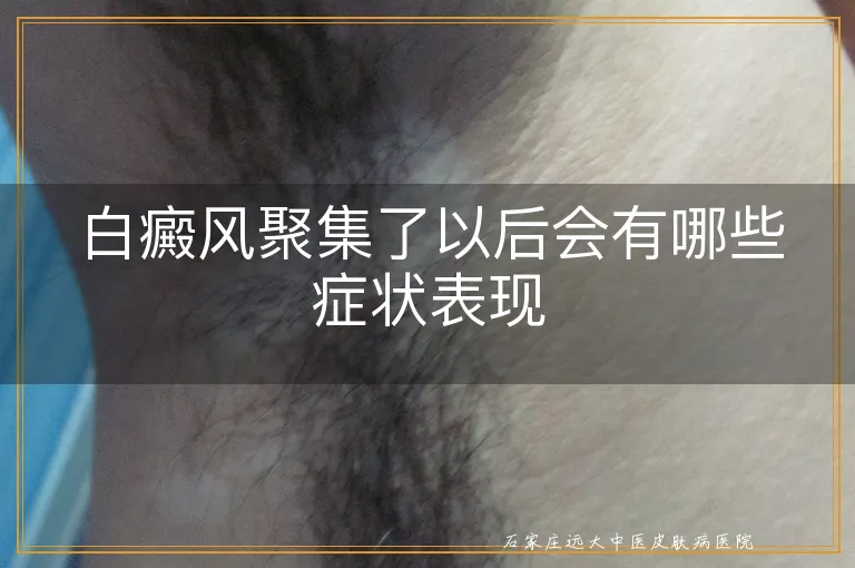 白癜风聚集了以后会有哪些症状表现