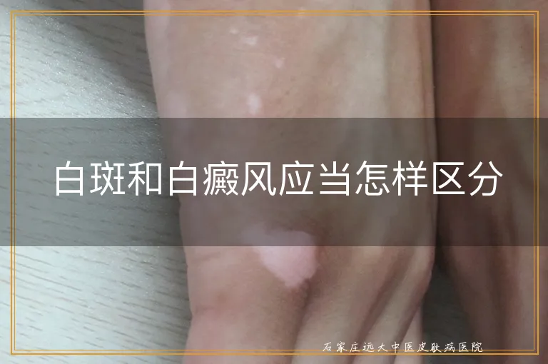 白斑和白癜风应当怎样区分