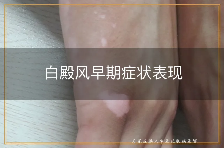 白殿风早期症状表现