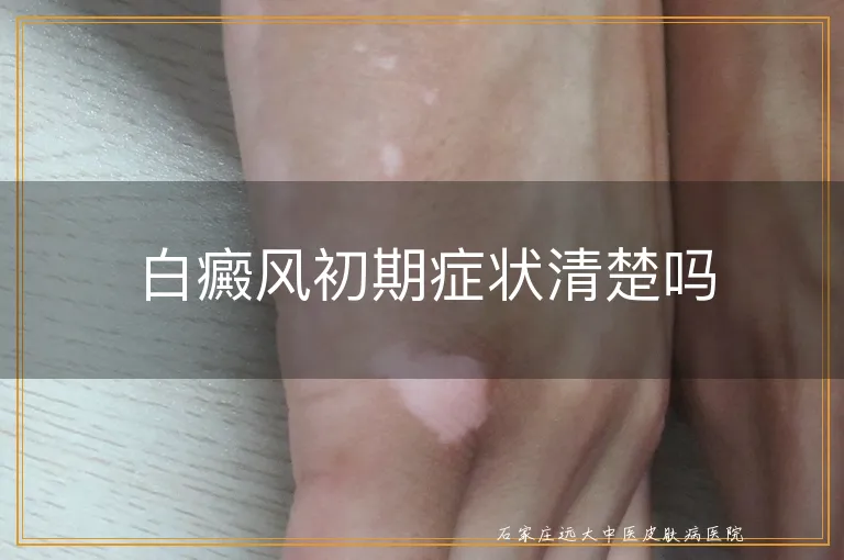 白癜风初期症状清楚吗