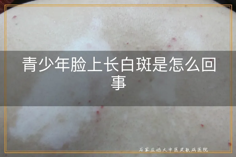 青少年脸上长白斑是怎么回事