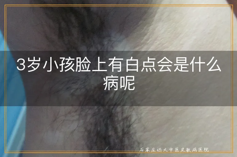 3岁小孩脸上有白点会是什么病呢