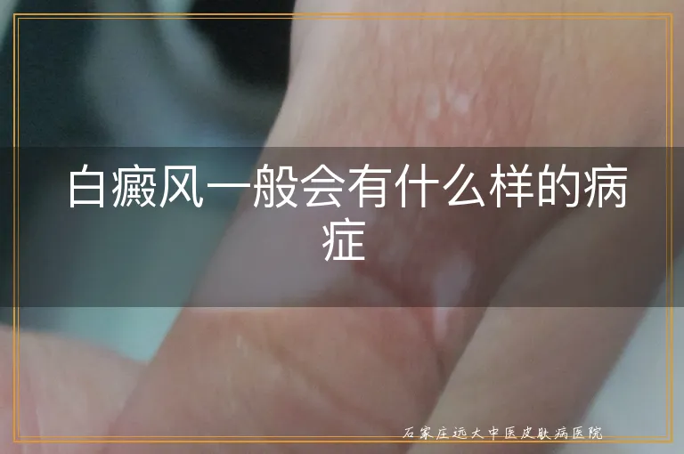 白癜风一般会有什么样的病症