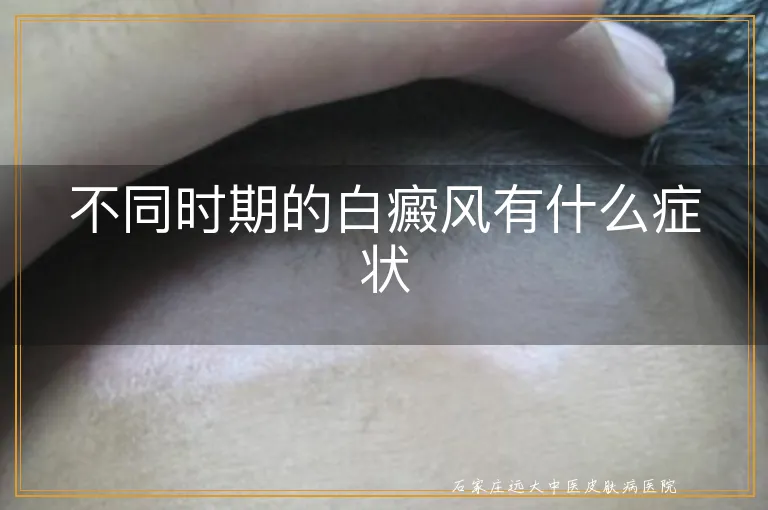 不同时期的白癜风有什么症状