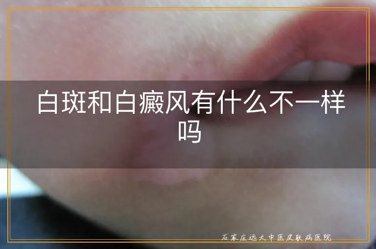 白斑和白癜风有什么不一样吗