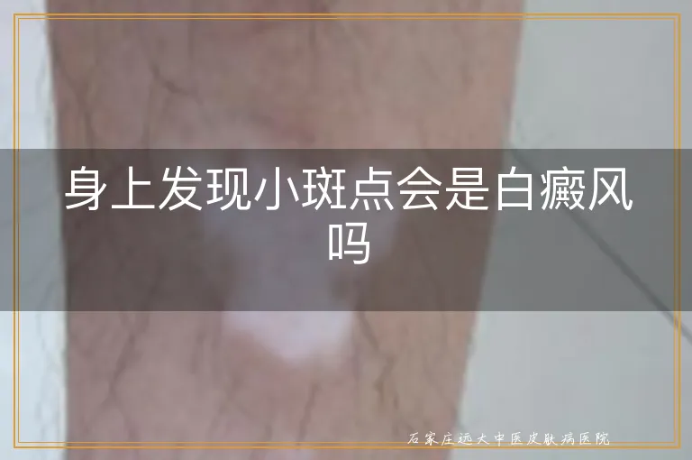 身上发现小斑点会是白癜风吗