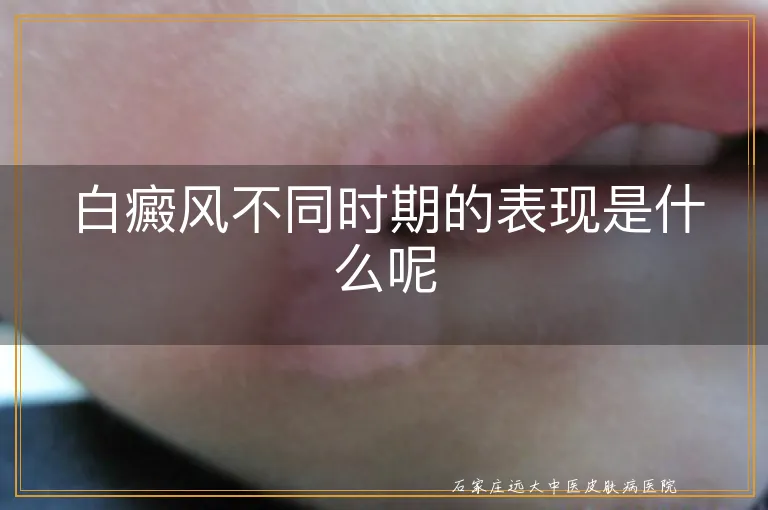 白癜风不同时期的表现是什么呢